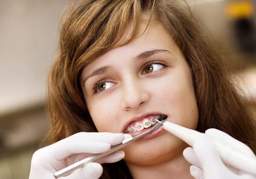 Enhancing Your Child's Smile: Visiting A Dentist For Orthodontic Braces In London