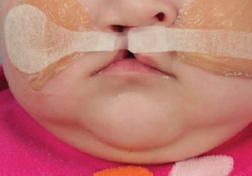 Caring for Children with Cleft Lip and Palate: A Pediatric Dentist's Perspective